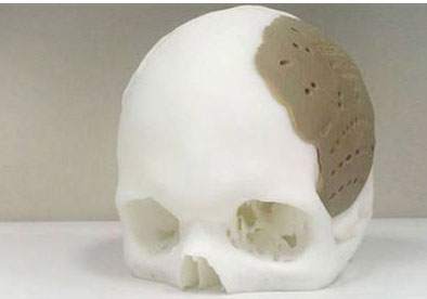 3D Yazıcıda Kafatası Protezi Üretildi