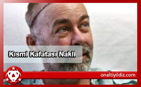 Kısmi Kafatası Nakli