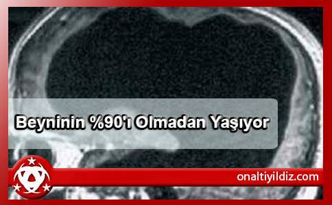 Beyninin %90'ı Olmadan Yaşıyor